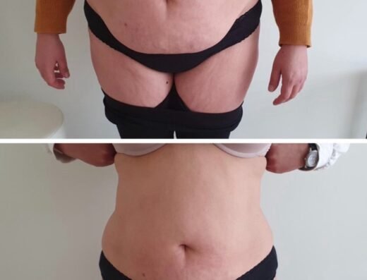 Cryolipolysis Abdomen 520x397