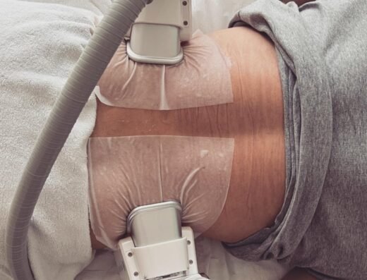 Cryolipolysis Love Handles 520x397