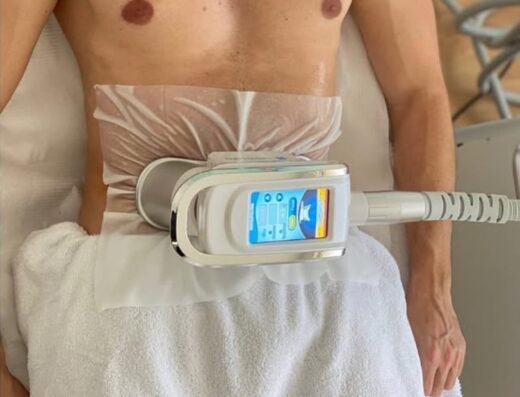 Cryolipolysis Man Abdomen 520x397